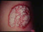 psoriasis.jpg (37028 bytes)