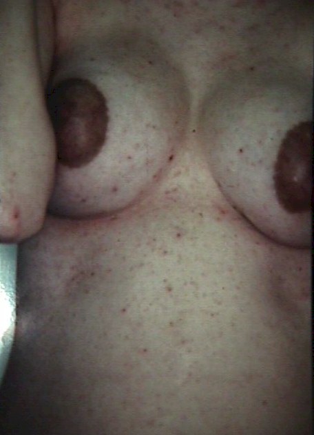 Scabies