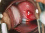 vagcyst640.jpg (50813 bytes)