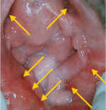 vestibulitis6.jpg (53586 bytes)