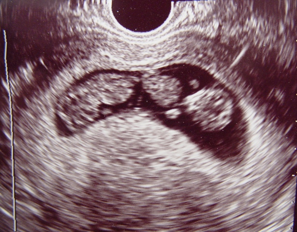 Ultrasound image of first trimester twins