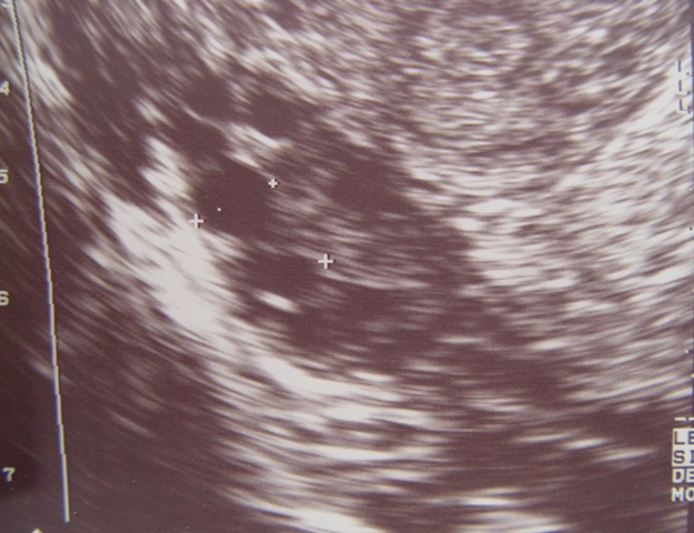 Ultrasound Image of a Polycystic Ovary