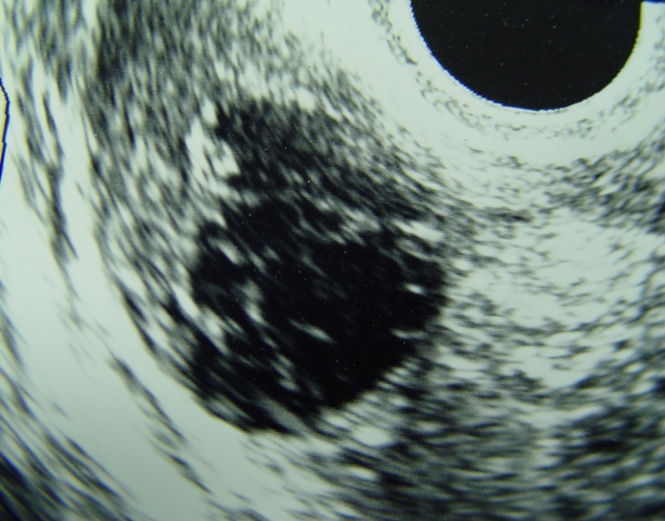 Ultrasound Image of a Hemorrhagic Corpus Luteum Cyst