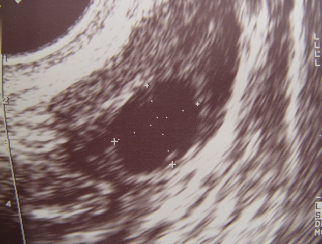 Ultrasound Image of a Normal Ovarian Follicle