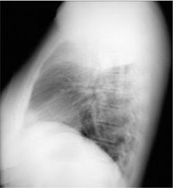 Right Upper Lobe Pneumonia