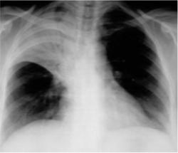 Right Upper Lobe Pneumonia
