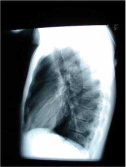 Normal Lateral Chest X-ray