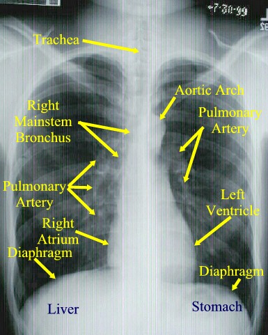 chest ray xray