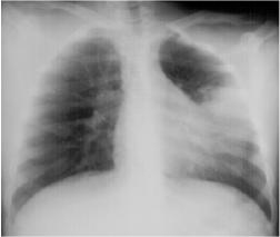 Left Lingular Pneumonia