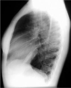 Left Lower Lobe Pneumonia, Anterior Segment