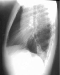 Left Lower Lobe Pneumonia, Posterior Segment