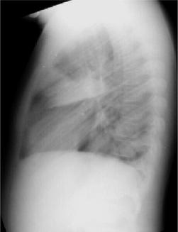 Right Lower Lobe Pneumonia, Superior Segment