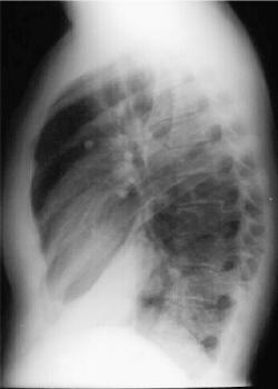 Right Lower Lobe Pneumonia