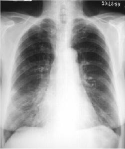 Right Middle Lobe Consolidation