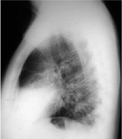Right Middle Lobe Pneumonia