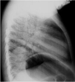 Round Pneumonia