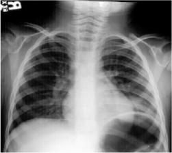 Round Pneumonia 