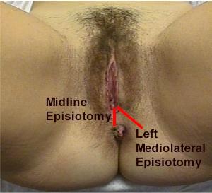 Episiotomy Video