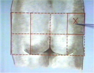 IM Injection Video