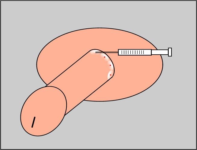 Ring Block for Circumcision