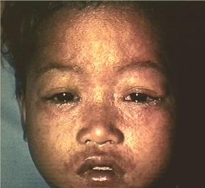 Measles (Rubeola, Morbilli, 9-Day Measles)