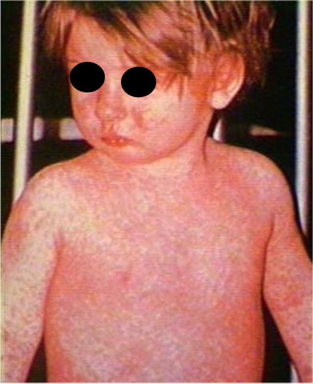 Measles (Rubeola, Morbilli, 9-Day Measles)