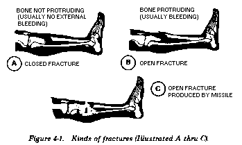 First aid shop for fracture