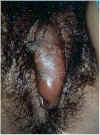 Abscess150.jpg (14302 bytes)