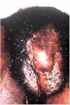 hematoma150.jpg (14939 bytes)