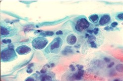 Severe_metaplastic_dysplasia250.jpg (14048 bytes)