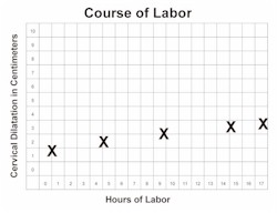 Prolonged Latent Phase Labor