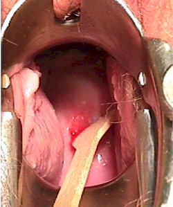 Pap smear