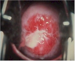 Chlamydia cervicitis