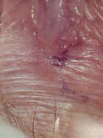 toluidine blue dye (rinsed with vinegar) can highlight recent trauma