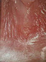 toluidine blue dye (rinsed with vinegar) can highlight recent trauma