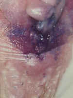 toluidine blue dye (rinsed with vinegar) can highlight recent trauma