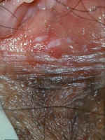 toluidine blue dye (rinsed with vinegar) can highlight recent trauma