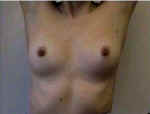 When raising her arms up, both breasts should rise evenly on the chest wall.