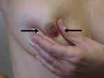 She should try to express nipple discharge by stripping the ducts towards the nipple.