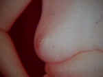 Inverted Nipples