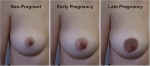 During pregnancy, a number of changes occur over time which prepare the breast for lactation