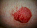 Paget's Disease