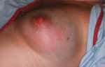 mastitis3.jpg (38374 bytes)