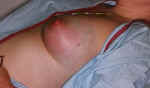 Puerperal Mastitis