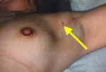 Supernumerary Nipples