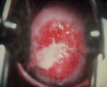 chlamydia1640.jpg (40738 bytes)