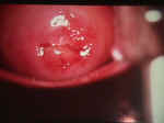 Apparently normal cervix