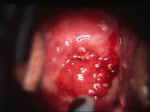 Cancer of the cervix