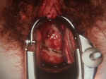 cxherpes.jpg (43967 bytes)