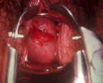 Endocervical polyp